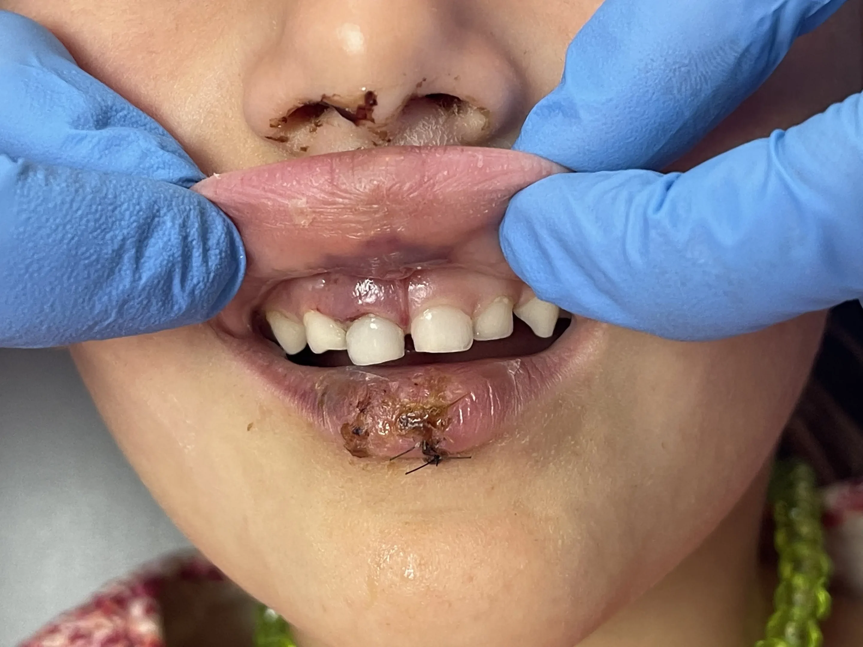 Traumatismos y fractura dental en niños - Dentistakids